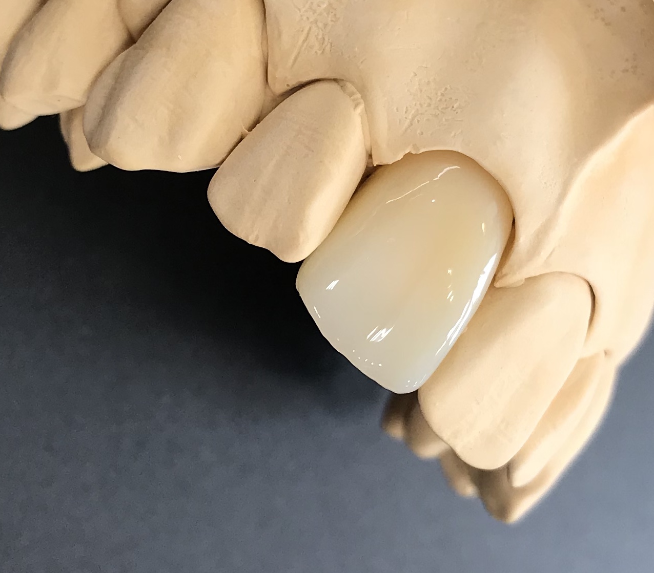 【保険治療】前歯のCAD/CAM冠取扱開始｜「くどう歯科医院」 - 三宮駅から徒歩6分の歯医者・歯科