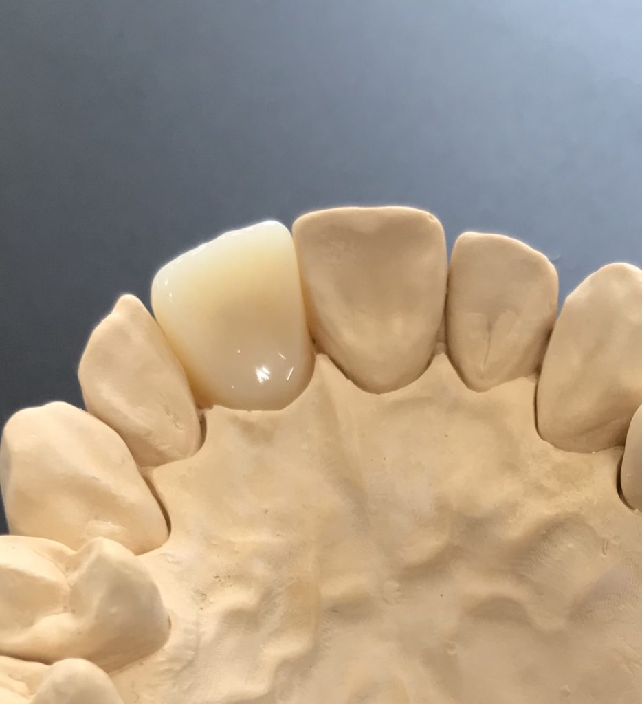 【保険治療】前歯のCAD/CAM冠取扱開始｜「くどう歯科医院」 - 三宮駅から徒歩6分の歯医者・歯科